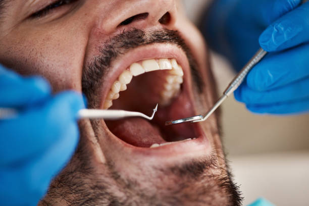 Best Emergency Dental Care for Broken or Chipped Teeth in Otisville, NY