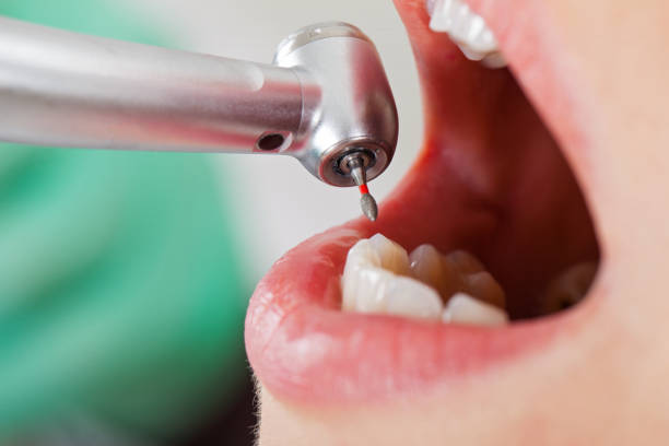 Best Emergency Dental Care for Broken or Chipped Teeth in Otisville, NY